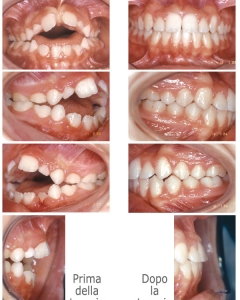 Ortodonzia intercettiva e definitiva