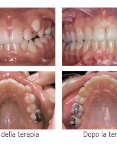 Ortodonzia degli adolescenti