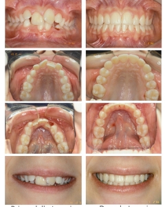 Ortodonzia intercettiva e definitiva