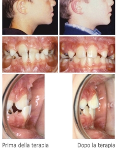 Ortodonzia intercettiva