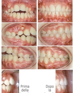 Ortodonzia degli adolescenti